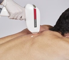 épilation défintive laser diode hd matrix 808 nm -1064 (nd yag) - 980 nm - homme dos